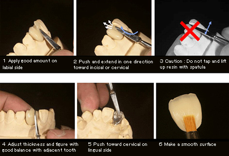 pic Procedure of Enamel build up