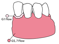 Pit and fissure01