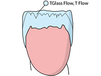 Inlay cavity01