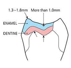 Posterior (Inlay)