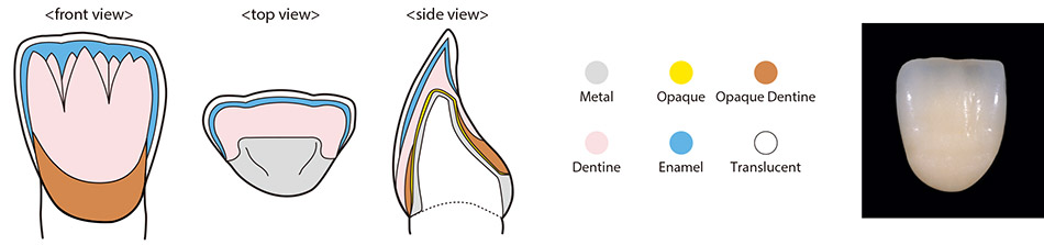Front Tooth (Using Translucent porcelain)